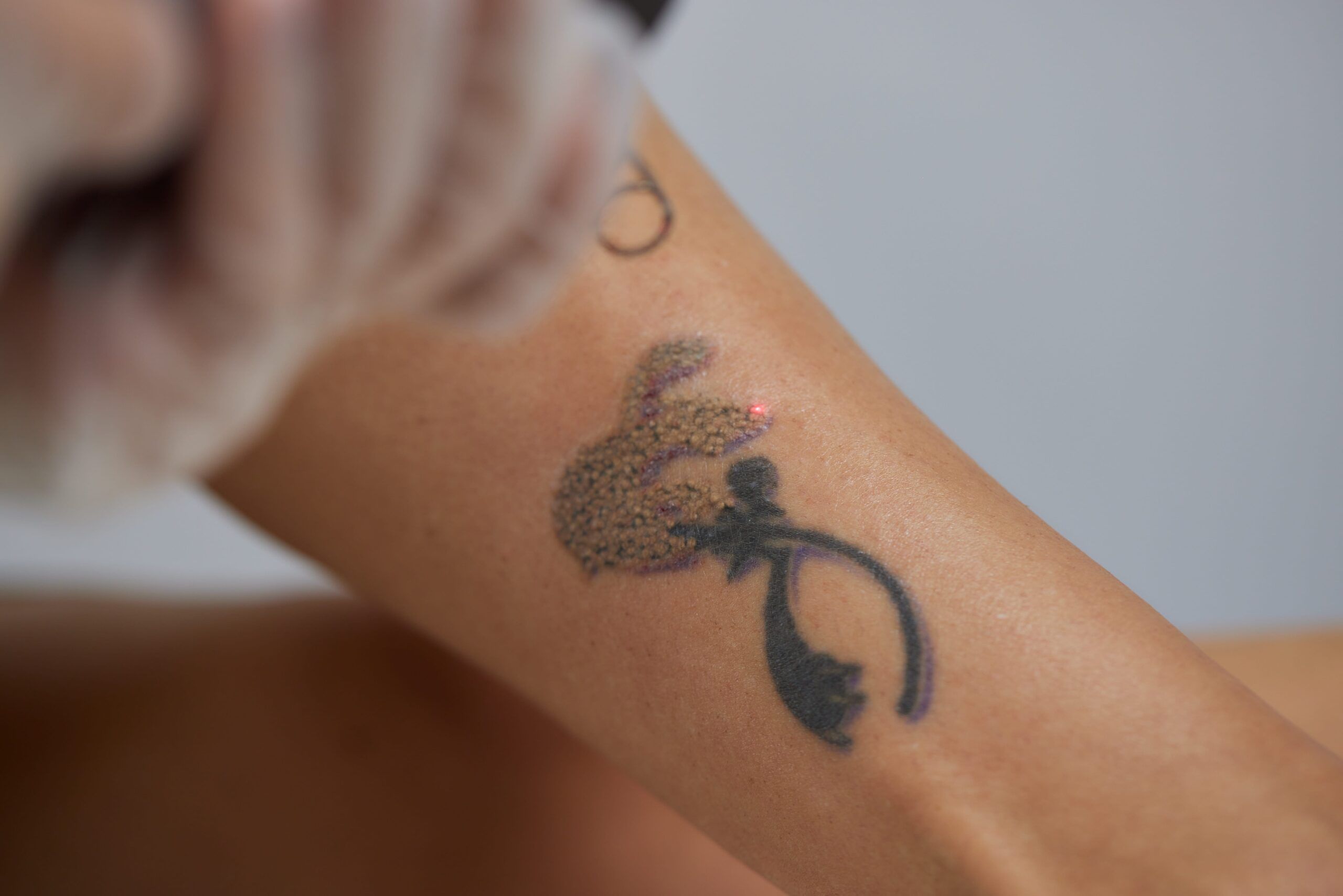 Young woman undergoing laser tattoo removal procedure in salon