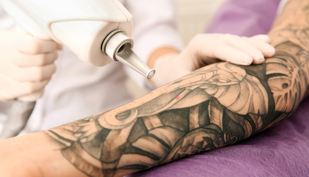 Laser Treatment for Tattoo Removal