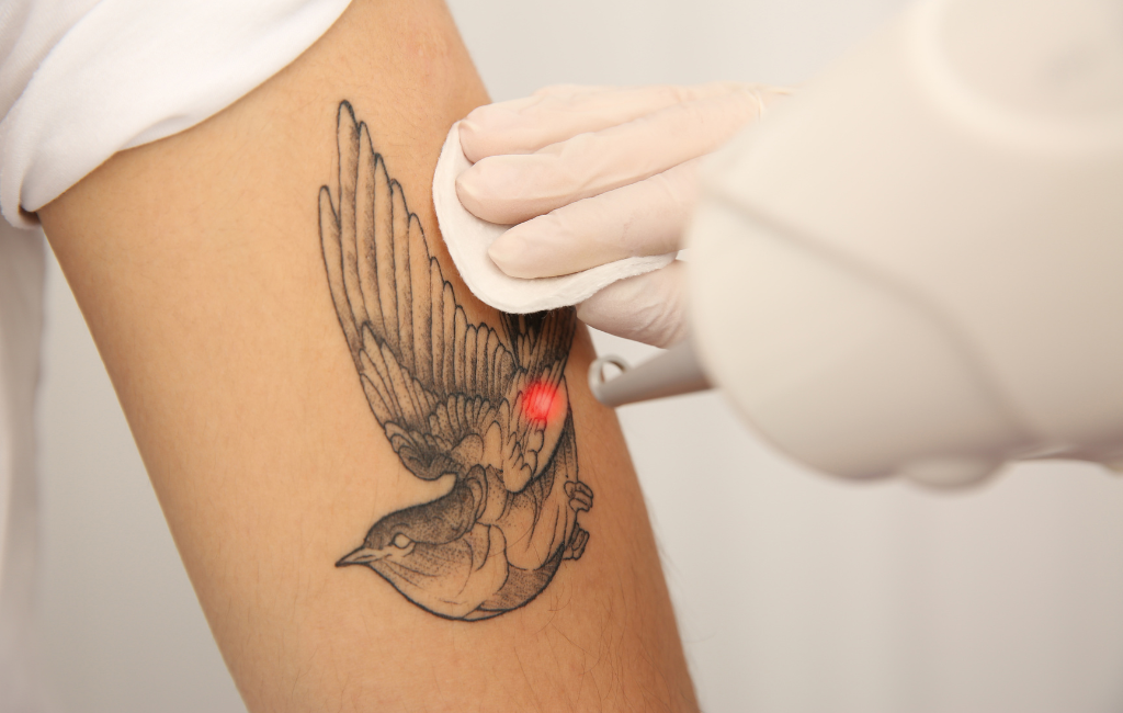 laser tattoo removal mississauga