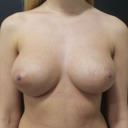 Patient After Breast Augmentation Treatment