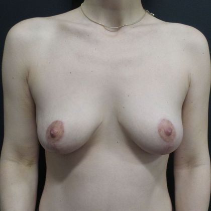 Patient After Breast Lift Treatment