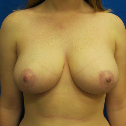 Patient After Breast Reduction Treatment