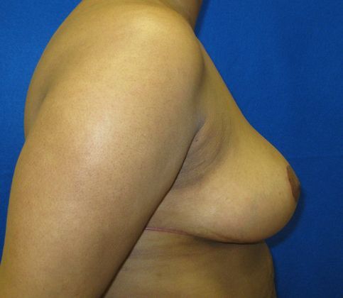 Patient After Breast Reduction Treatment