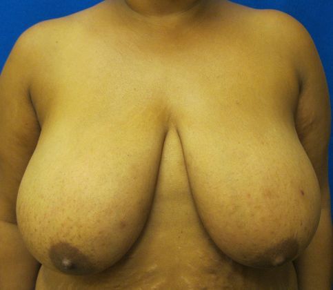 Patient Before Breast Reduction Treatment