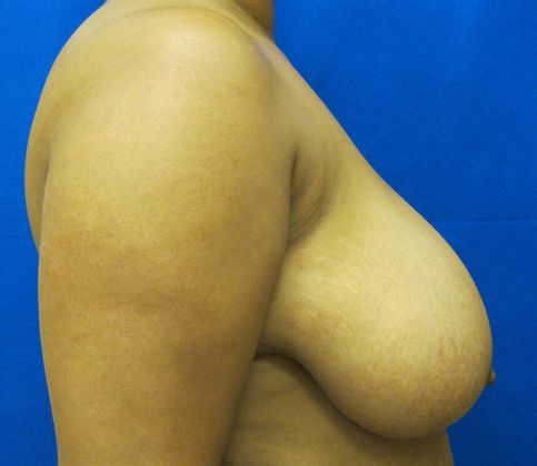 Patient Before Breast Reduction Treatment