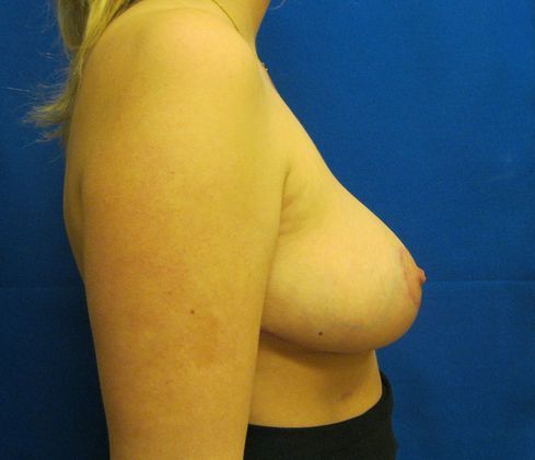 Patient After Breast Reduction Treatment