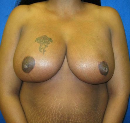 Patient After Breast Reduction Treatment