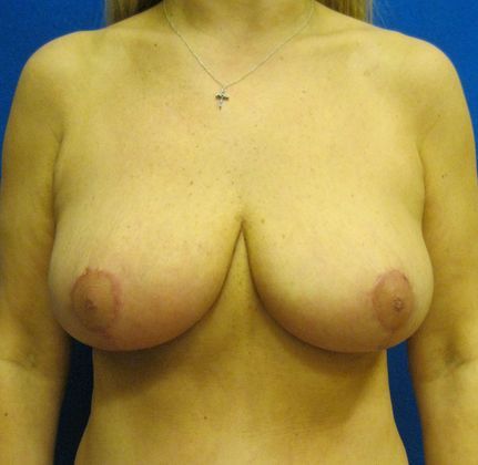 Patient After Breast Reduction Treatment