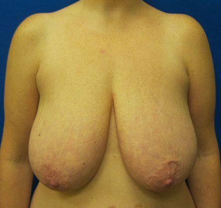 Patient Before Breast Reduction Treatment