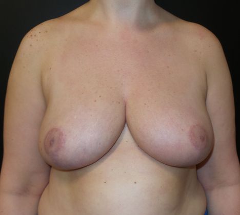 Patient After Breast Reduction Treatment