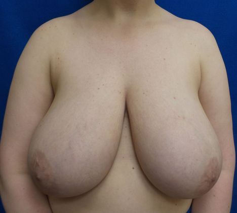 Patient Before Breast Reduction Treatment