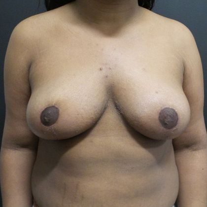 Patient After Breast Reduction Treatment