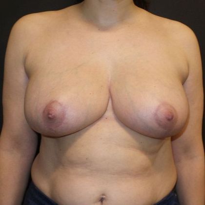 Patient After Breast Reduction Treatment