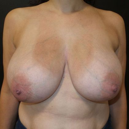 Patient Before Breast Reduction Treatment