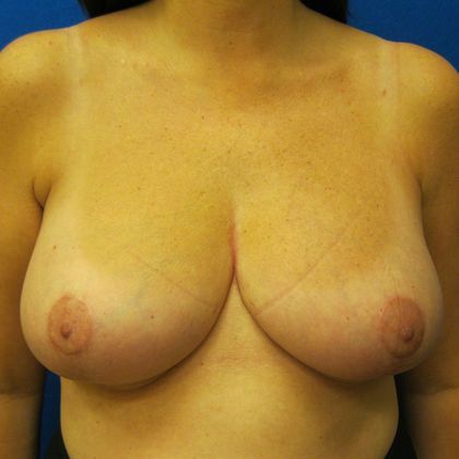 Patient After Breast Reduction Treatment