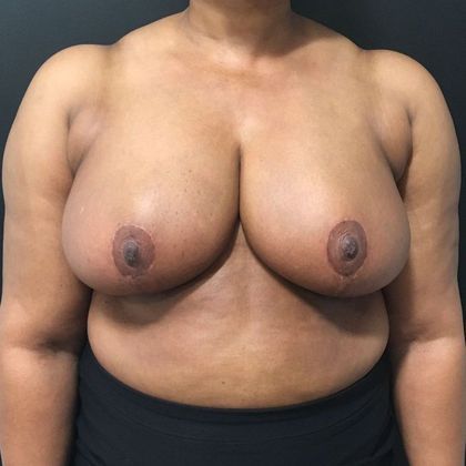 Patient After Breast Reduction Treatment