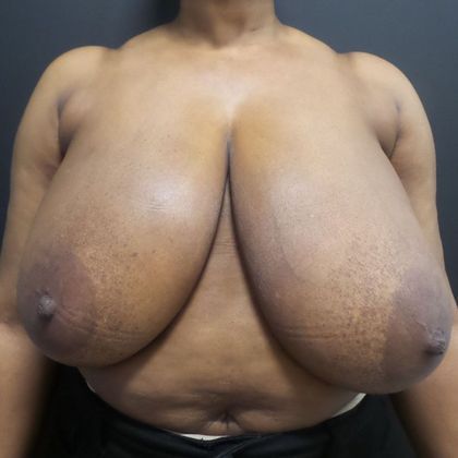 Patient Before Breast Reduction Treatment