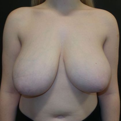 Patient Before Breast Reduction Treatment