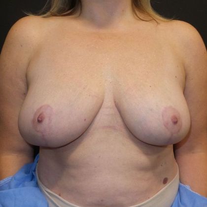 Patient After Breast Reduction Treatment