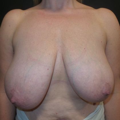 Patient Before Breast Reduction Treatment