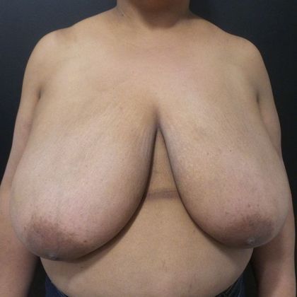 Patient Before Breast Reduction Treatment