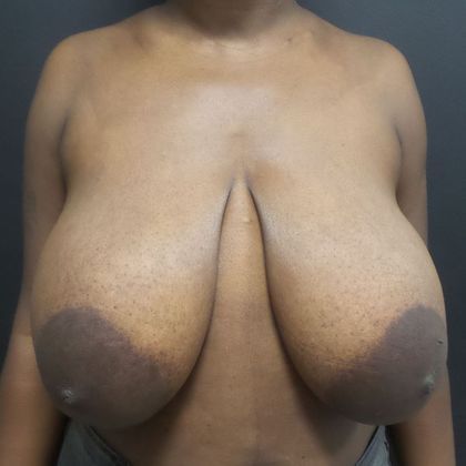 Patient Before Breast Reduction Treatment