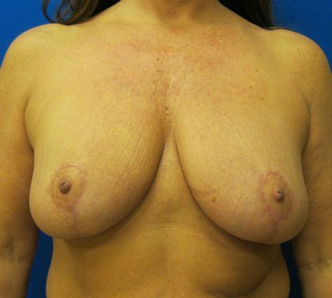 Patient After Breast Reduction Treatment