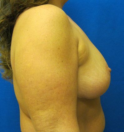 Patient After Breast Reduction Treatment