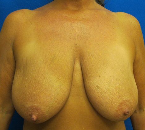 Patient Before Breast Reduction Treatment