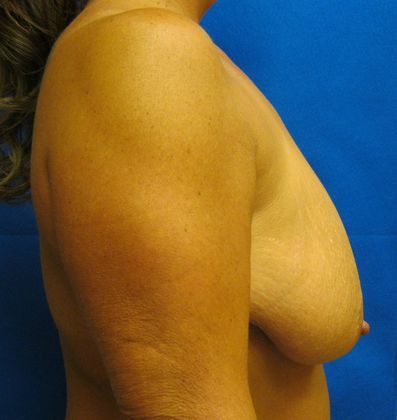 Patient Before Breast Reduction Treatment