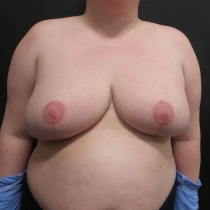 Patient After Breast Reduction Treatment