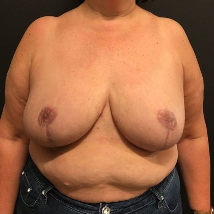 Patient After Breast Reduction Treatment