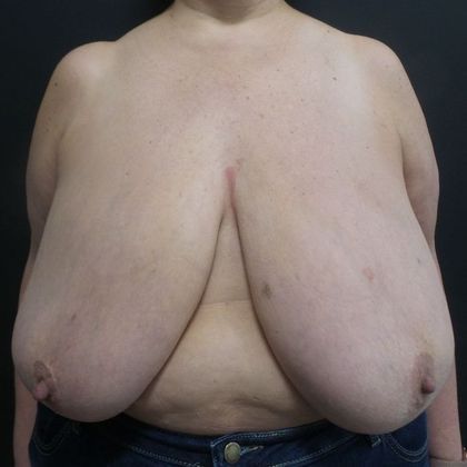 Patient Before Breast Reduction Treatment