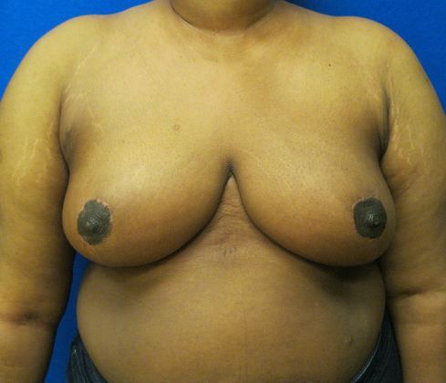 Patient After Breast Reduction Treatment