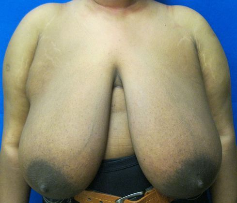 Patient Before Breast Reduction Treatment