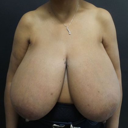 Patient Before Breast Reduction Treatment