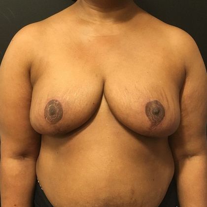 Patient After Breast Reduction Treatment