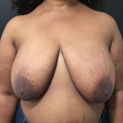 Patient Before Breast Reduction Treatment