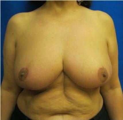 Patient After Breast Reduction Treatment