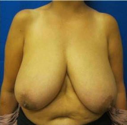 Patient Before Breast Reduction Treatment