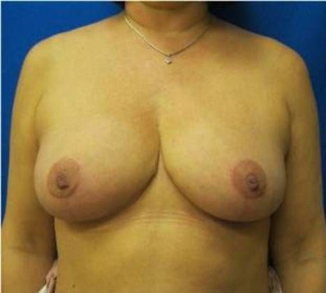 Patient After Breast Reduction Treatment