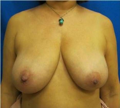 Patient Before Breast Reduction Treatment