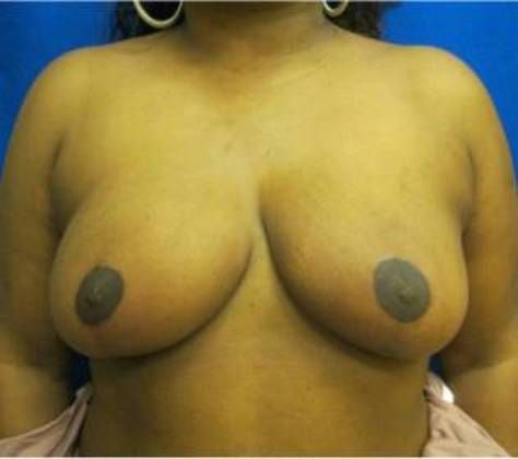 Patient After Breast Reduction Treatment