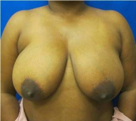 Patient Before Breast Reduction Treatment