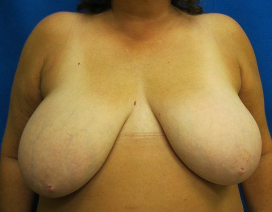 Patient Before Breast Reduction Treatment