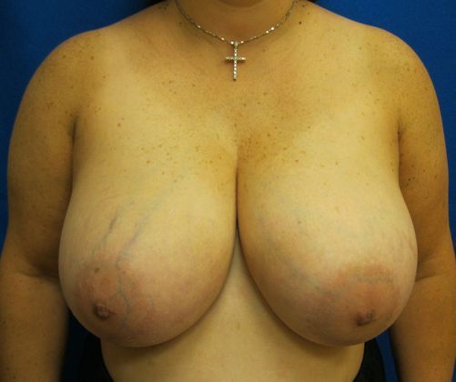 Patient Before Breast Reduction Treatment