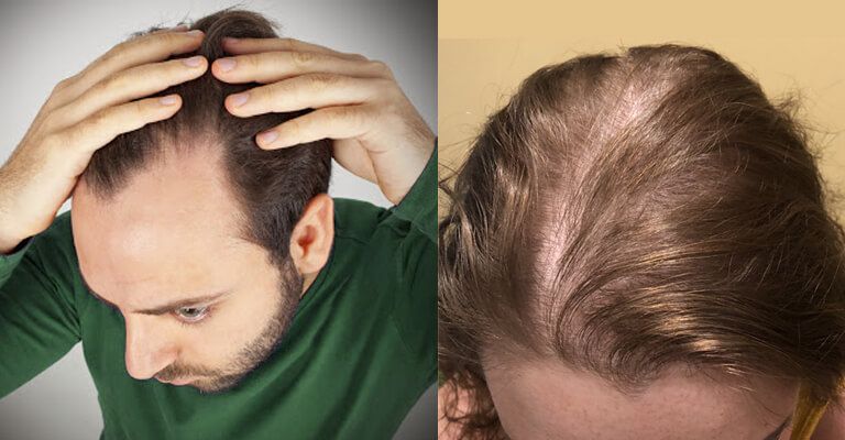 Early Age Balding – Here’s What To Know | L&P Aesthetics