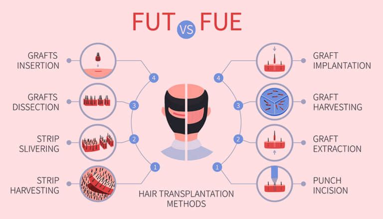 FUE Vs FUT Hair Transplant