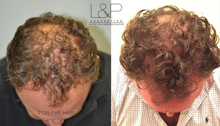 Hair Loss After Chemotherapy Meet Andrew Real Patient