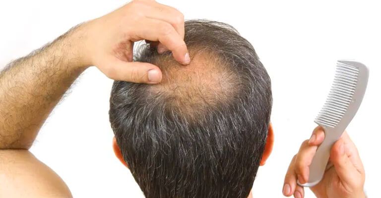 The Top Common Hair Loss Myths